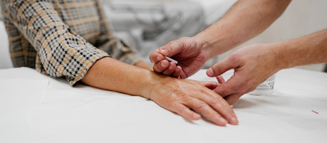 L'acupuncture pour lutter contre le syndrome du canal carpien